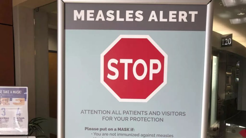 AHS confirms case of measles in Edmonton